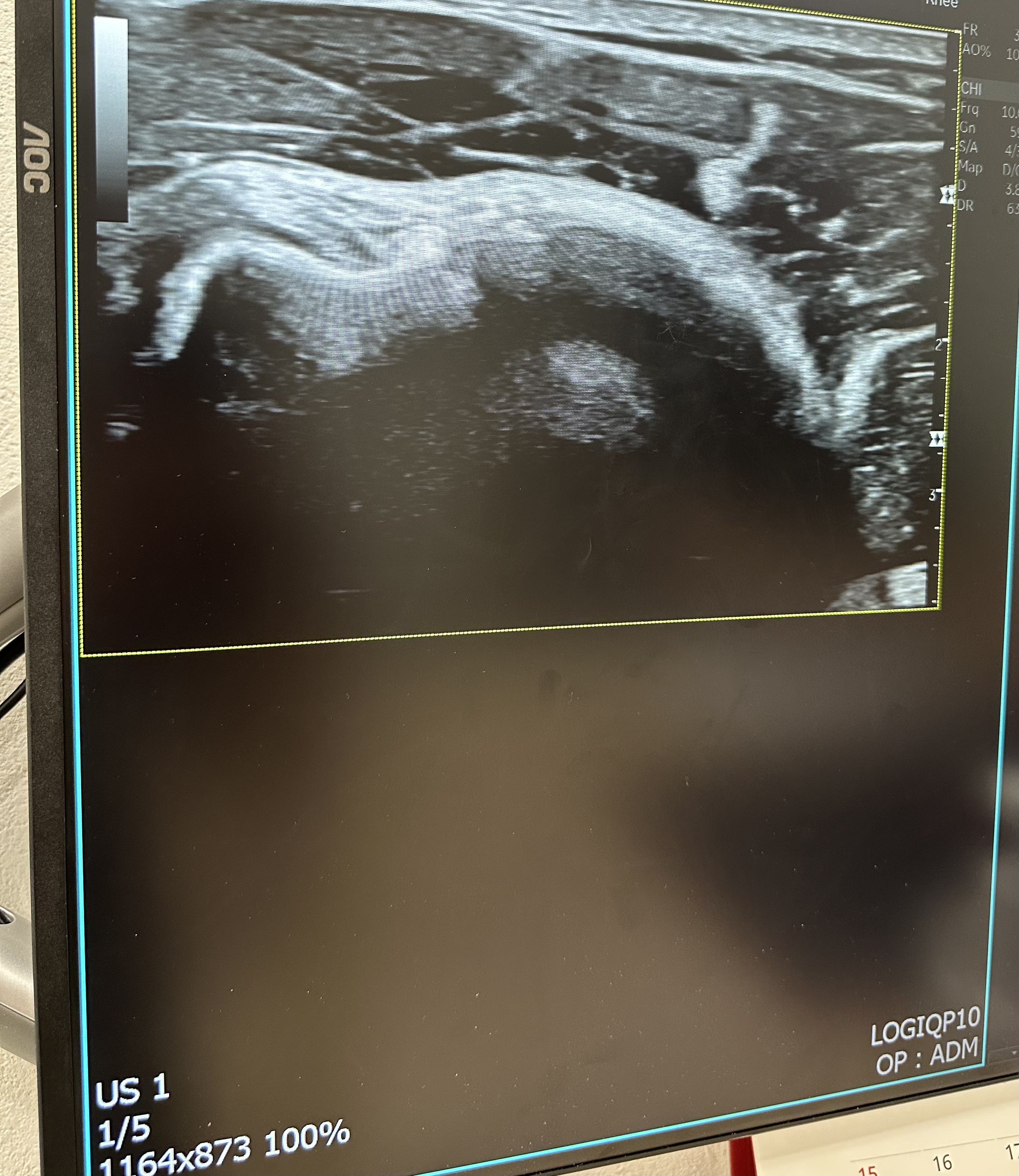 Shoulder ultrasound